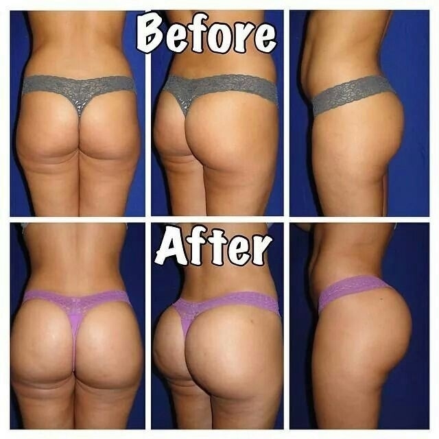 Nasha Technology Biphasic Injectable Hyaluronic Acid Dermal Filler Cross Linked 1ml