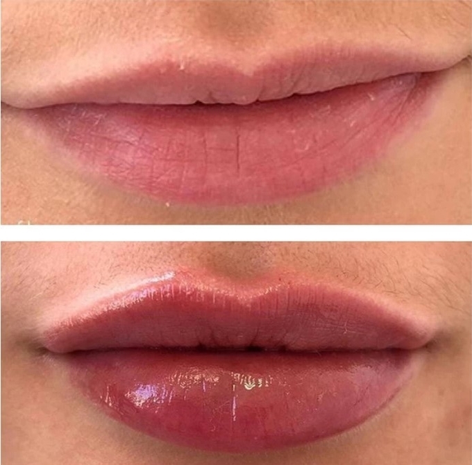 3ml Injectable Hyaluronic Acid Dermal Filler Crosslinked And Non Crosslinked Gel
