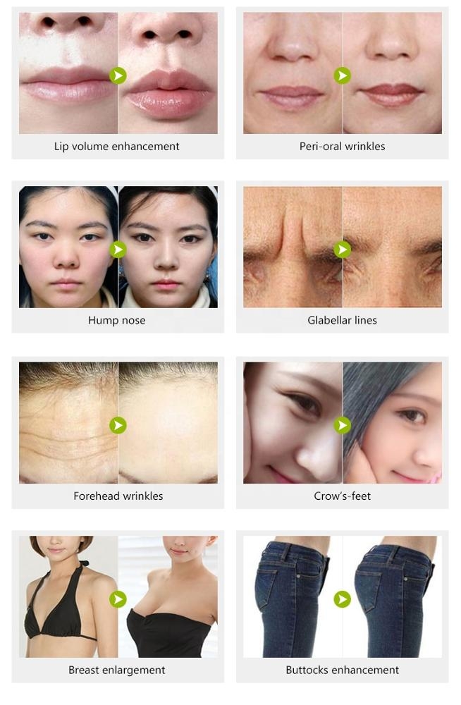 Academy 24mg/Ml Injectable Hyaluronic Acid Dermal Filler 2ml