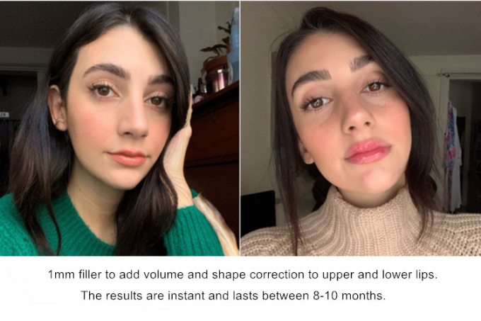 hyaluronic acid fillers lip fillers hyaluronic acid injections for pen and micro-needle treatment 3